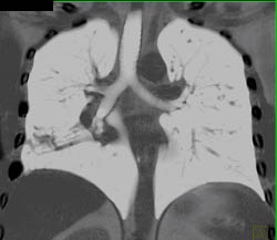 Bronchiectasis - CTisus CT Scan