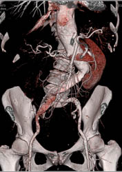 Type B Dissection - CTisus CT Scan