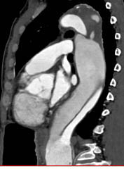 Type B Dissection - CTisus CT Scan