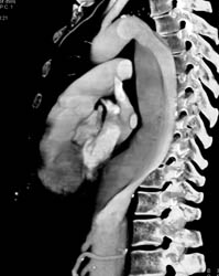 Type B Dissection - CTisus CT Scan