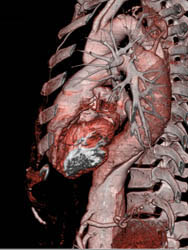 Type B Dissection - CTisus CT Scan