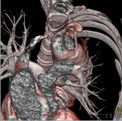 Type B Dissection - CTisus CT Scan