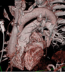 Type B Dissection - CTisus CT Scan