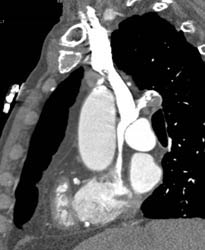 Dilated Aortic Root - CTisus CT Scan