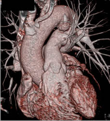 Dilated Aortic Root - CTisus CT Scan