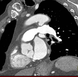 Dilated Aortic Root - CTisus CT Scan