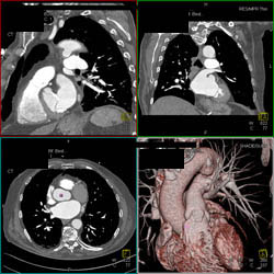 Dilated Aortic Root - CTisus CT Scan