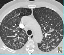 Lymphangetic Spread - CTisus CT Scan