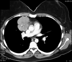 Lymphoma - CTisus CT Scan