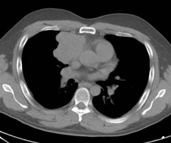 Thymoma - CTisus CT Scan