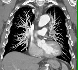 Ductus Aneurysm - CTisus CT Scan