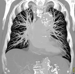 Ductus Aneurysm - CTisus CT Scan