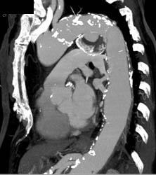 Ductus Aneurysm - CTisus CT Scan