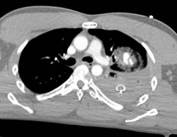 Pulmonary Artery Aneurysm S/P GSW - CTisus CT Scan