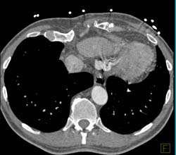 Repair of Ascending Aorta With Post Op Change - CTisus CT Scan