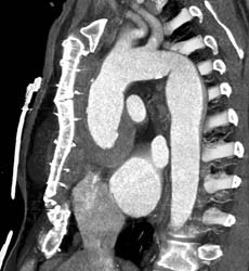 Chest Wall Abscess as Presentation of Pseudoaneurysm of Ascending Aorta - CTisus CT Scan