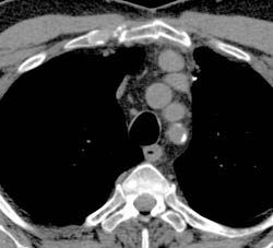 Focal Aneurysm Off Arch- See Sequence - CTisus CT Scan