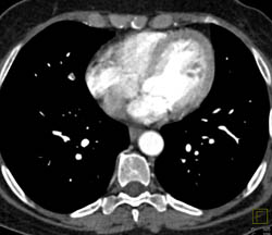 Pulmonary Embolism - CTisus CT Scan