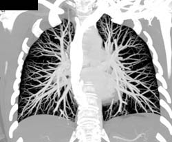 Pulmonary Embolism - CTisus CT Scan