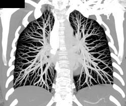 Pulmonary Embolism - CTisus CT Scan