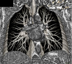 Pulmonary Embolism - CTisus CT Scan