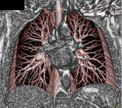 Pulmonary Embolism - CTisus CT Scan