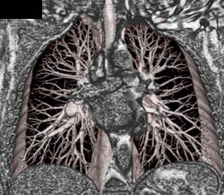 Node in Right Hilum - CTisus CT Scan