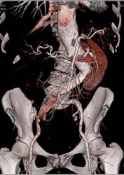 Type B Dissection - CTisus CT Scan