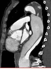 Type B Dissection - CTisus CT Scan