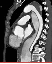 Type B Dissection - CTisus CT Scan