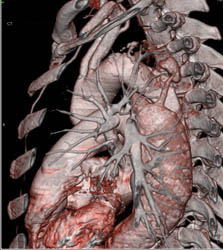 Type B Dissection - CTisus CT Scan