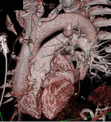 Ductus Aneurysm - CTisus CT Scan