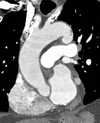 Diseased Branch Vessels Off the Arch and Ductus Aneurysm - CTisus CT Scan