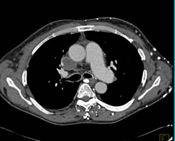 SVC Thrombus With Collaterals - CTisus CT Scan