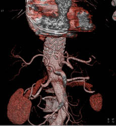 Stent Repair of Type B Dissection - CTisus CT Scan