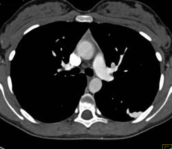 Pulmonary Arteriovenous Malformation (PAVM) - CTisus CT Scan