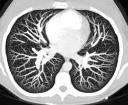 Pulmonary Arteriovenous Malformation (PAVM) - CTisus CT Scan