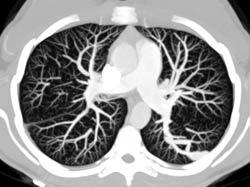 Pulmonary Arteriovenous Malformation (PAVM) - CTisus CT Scan