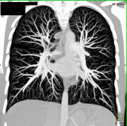 Pulmonary Arteriovenous Malformation (PAVM) - CTisus CT Scan