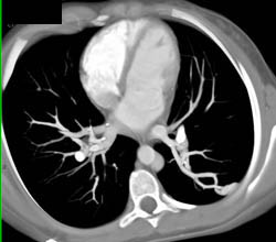 Pulmonary Arteriovenous Malformation (PAVM) - CTisus CT Scan