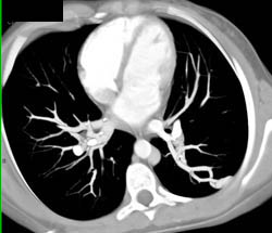 Pulmonary Arteriovenous Malformation (PAVM) - CTisus CT Scan