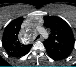 Metastatic Sarcoma to Chest- Calcified Masses- Chondrosarcoma - CTisus CT Scan