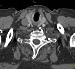 Aortic Dissection Type A Involves Carotid Arteries - CTisus CT Scan