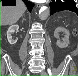 Dissection With Delayed Flow Into False Lumen. See Delayed Function Left Kidney - CTisus CT Scan