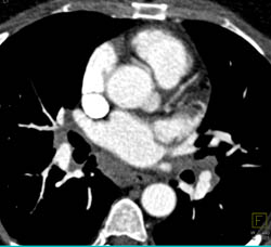 Mediastinal Nodes Due to Lymphoma - CTisus CT Scan