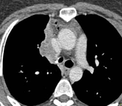 Collapse Right Upper Lung With Broncholith and Upper Lung Collapse - CTisus CT Scan