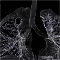 Tracheal Stenosis Right Mainstem Bronchus - CTisus CT Scan