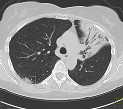 Bronchiectasis Left Upper Lobe - CTisus CT Scan