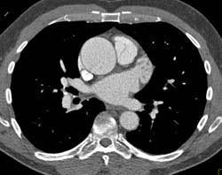 Bicuspid Valve and Aortic Stenosis - CTisus CT Scan