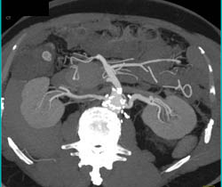 Repair of Aorta and Iliac Artery in 3D - CTisus CT Scan